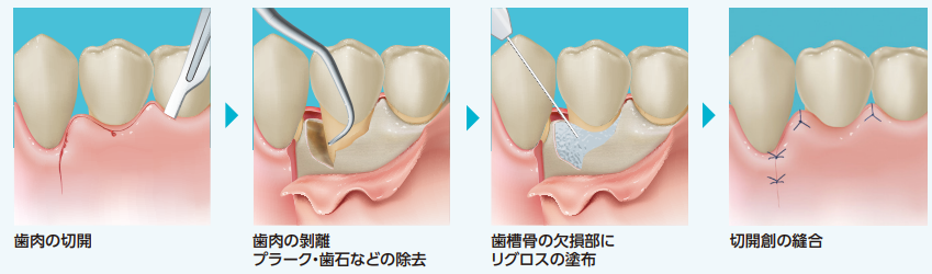 先進医療が保険適用になりました ヒポ通信 江頭歯科医院