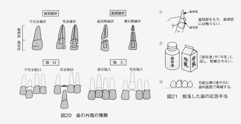 歯 口の外傷とその予防 ヒポ通信 江頭歯科医院